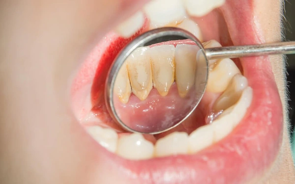 Cao răng là một vấn đề phổ biến trong việc chăm sóc răng miệng