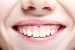 Cười hở lợi là gì? Cách khắc phục cười hở lợi a toàn hiệu quả