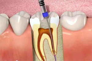 Lấy tủy răng là một quá trình y tế được thực hiện để loại bỏ toàn bộ dây thần kinh, mô liên kết và các tạp chất trong răng