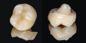 Endocrown là gì? Giải pháp thay thế bọc sứ tốt nhất