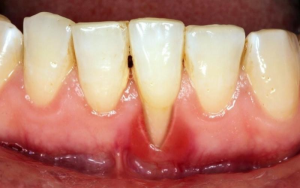 tụt lợi có tự khỏi không