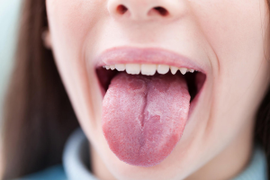 Miệng bị chát là bệnh gì? Nguyên nhân và cách điều trị hiệu quả