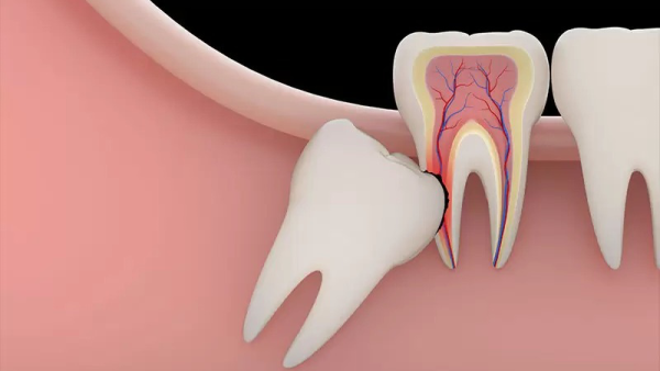 Khi răng khôn mọc lệch 45 độ, chúng có thể đẩy vào các răng lân cận, gây ra hiện tượng chen lấn răng