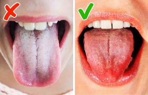 Lưỡi trắng kèm hôi miệng: Nguyên nhân và cách điều trị an toàn