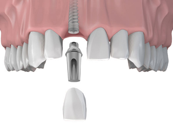 Implant là một phương pháp hiệu quả và bền vững để khắc phục tình trạng gãy răng cửa