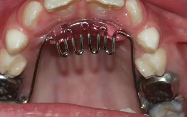 Tật đẩy lưỡi: Nguyên nhân, tác hại và cách điều trị Đeo bám cố định là một phương pháp nha khoa phổ biến giúp khắc phục tật đẩy lưỡi