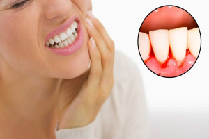Miệng tiết nhiều nước bọt là bệnh gì? Điều trị như thế nào?