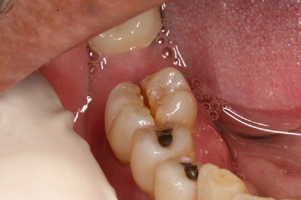 Răng số 6 hàm trên là gì? Có nên nhổ hay không? Hình ảnh minh họa răng số 6