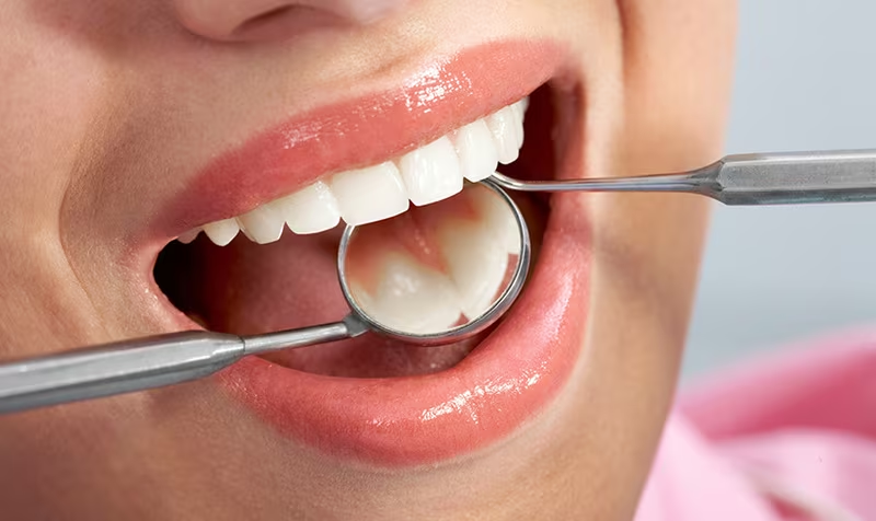Trường hợp răng mọc trong vòm miệng gây quá nhiều khó khăn thì cần quyết định trích răng Trường hợp răng mọc trong vòm miệng gây quá nhiều khó khăn thì cần quyết định trích răng