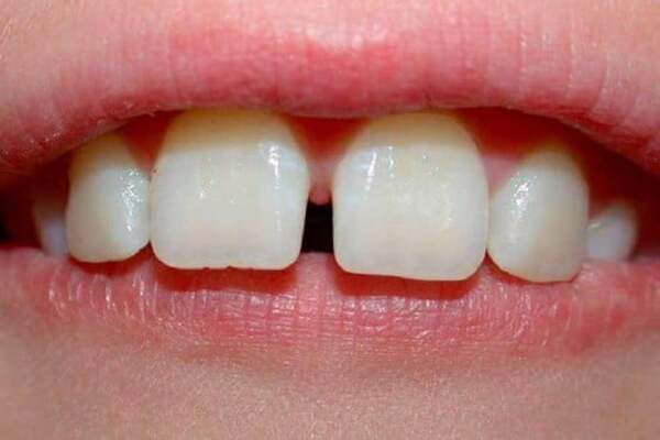 Bẩm sinh dẫn đến răng cửa thưa