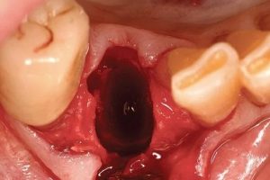 12 dấu hiệu nhiễm trùng sau khi nhổ răng khôn và cách điều trị