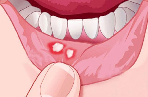 Nhiệt miệng gây ra những cơn đơn và khó chịu trong miệng Nhiệt miệng gây ra những cơn đơn và khó chịu trong miệng
