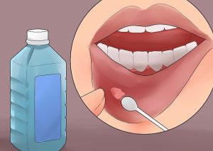 Nhiệt miệng điều trị tại nhà đơn giản