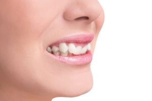 Răng lồi xỉ là gì? Nguyên nhân và cách điều trị hiệu quả nhất