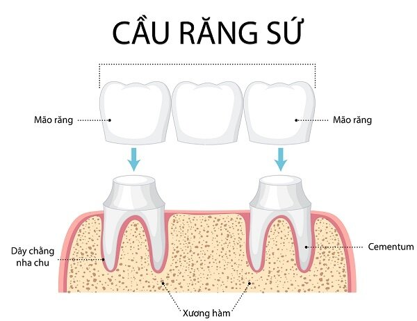 Cầu răng sứ là gì? Cầu răng sứ là gì?