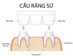 Cầu răng sứ là gì? Làm cầu răng sứ có tốt không?