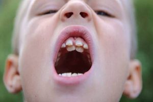 Răng mọc lẫy: Nguyên nhân, dấu hiệu, cách khắc phục