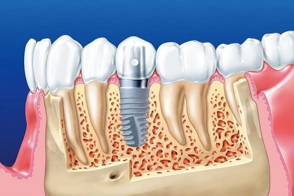 Khám phá quy trình trồng răng giả Khám phá quy trình trồng răng giả