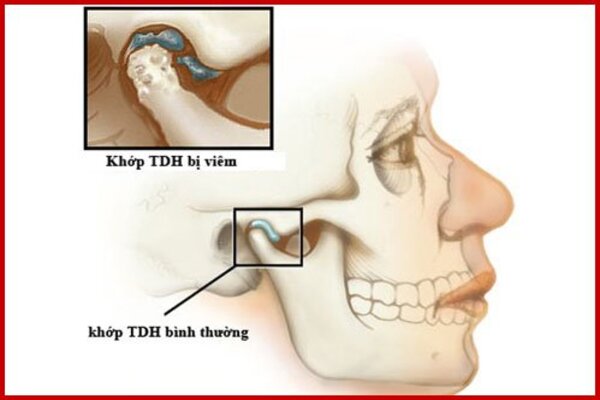 Viêm khớp thái dương hàm: Những thông tin cần biết Định nghĩa về khớp thái dương hàm