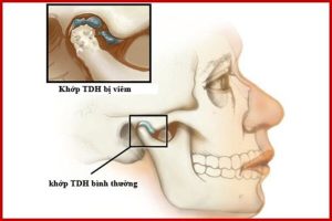 Viêm khớp thái dương hàm: Những thông tin cần biết