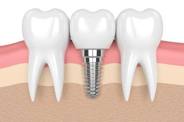 Cách giảm đau khi trồng răng giả Cách giảm đau khi trồng răng giả