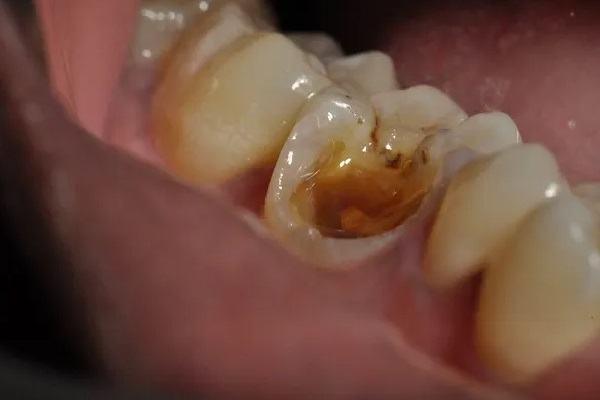 Răng số 6 hàm trên là gì? Có nên nhổ hay không? Hệ lụy nguy hiểm khi mất răng số 6