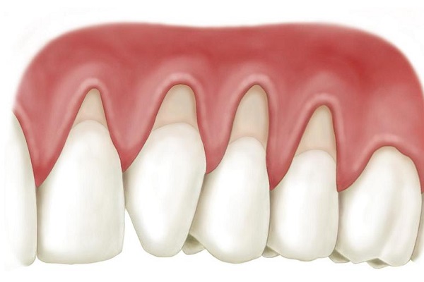 Hướng dẫn chăm sóc chân răng