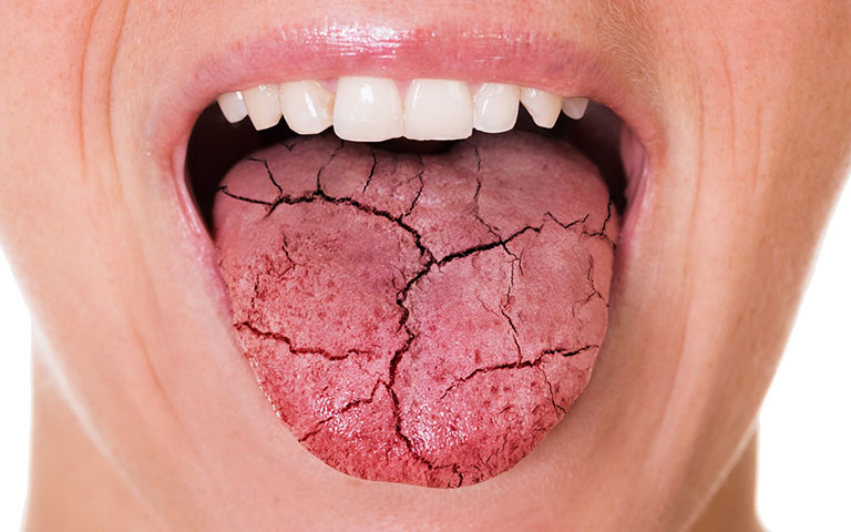 Khô miệng khát nước gây khó chịu trong cuộc sống hằng ngày