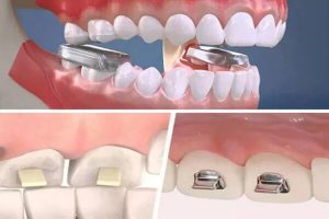 Nâng khớp cắn là gì? Có tác dụng gì trong niềng răng?