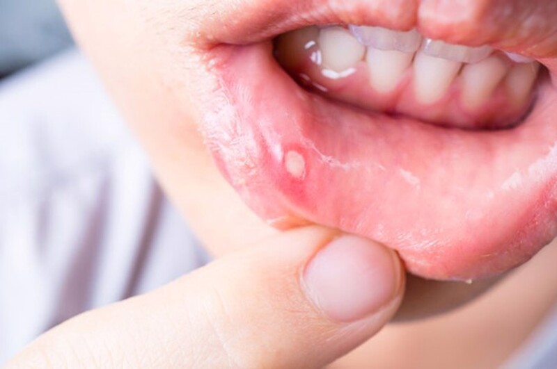 Nhiệt miệng không nguy hiểm nhưng gây đau đớn khó chịu Nhiệt miệng không nguy hiểm nhưng gây đau đớn khó chịu