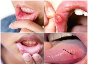 Nguyên nhân gây nhiệt miệng, nhiệt lưỡi như vi khuẩn, nấm, không chăm sóc răng miệng