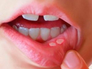 Nhiệt miệng gây khó chịu trong ăn uống