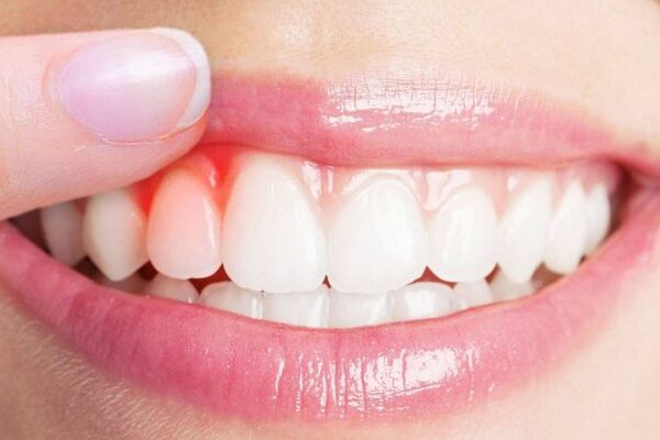 Đồ ăn nên ăn khi siết răng khi niềng là gì