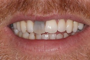 Răng cửa bị sâu có trám được không? Giá bao nhiêu tiền?