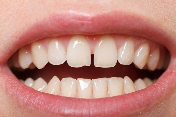 Rụng răng sớm cũng có thể do răng cửa thưa