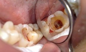 Răng sâu vào tủy: Nguyên nhân, triệu chứng và cách điều trị