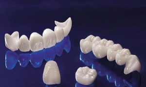 Răng toàn sứ - Loại nào phù hợp với bạn?