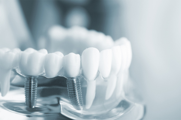 Răng toàn sứ - Loại nào phù hợp với bạn? Trồng răng toàn sứ Implant