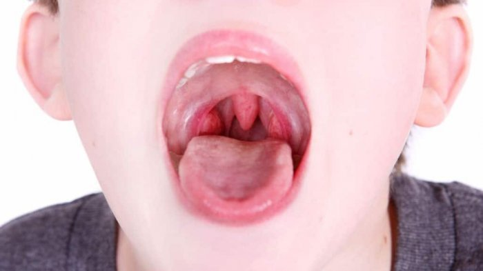 Nguyên nhân sưng vòm miệng trên như tổn thương miệng, nhiễm trùng hay bị dị ứng Nguyên nhân sưng vòm miệng trên như tổn thương miệng, nhiễm trùng hay bị dị ứng