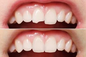 Trám răng cửa trong những trường hợp nào và những điều lưu ý