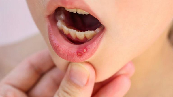 Viêm đỏ niêm mạc miệng là xuất hiện các vết loét và trở nên đỏ sậm Viêm đỏ niêm mạc miệng là xuất hiện các vết loét và trở nên đỏ sậm