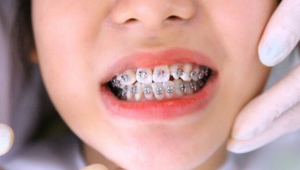 16 tuổi niềng răng bao nhiêu tiền