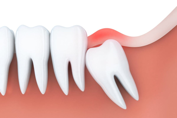 Giữ lại răng khôn có thể gây sưng, đau và viêm lợi, tạo điều kiện cho vi khuẩn gây sâu răng