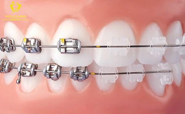 Niềng răng với phương pháp mắc cài