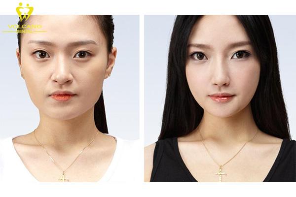 Phẫu thuật nâng hoặc hạ gò má có thể là giải pháp cuối cùng Phẫu thuật nâng hoặc hạ gò má có thể là giải pháp cuối cùng