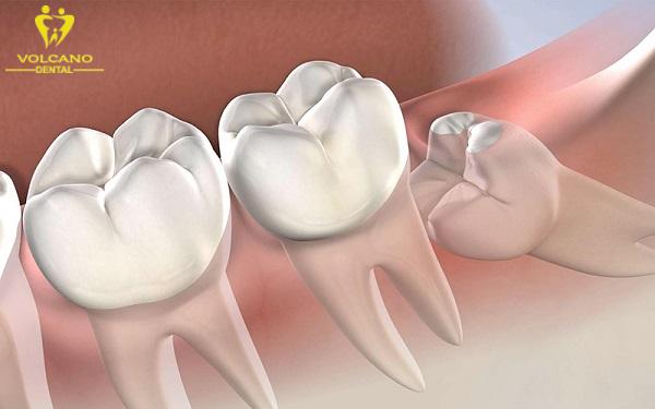 Răng khôn có thể có hoặc không ở một số người Răng khôn có thể có hoặc không ở một số người