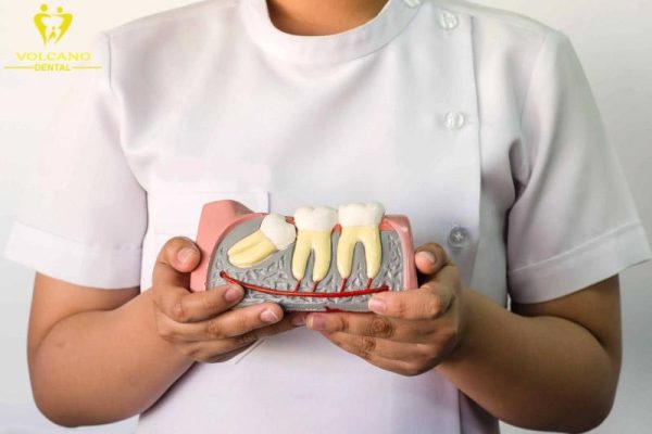 Không nhổ răng khôn không phải là một vấn đề nghiêm trọng Không nhổ răng khôn không phải là một vấn đề nghiêm trọng