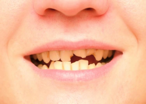Gãy răng ảnh hưởng như thế nào đến thẩm mỹ