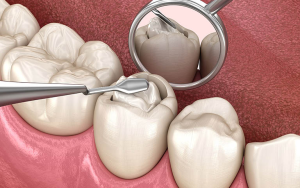 Cách phục hồi răng bị mẻ tại nhà hiệu quả và an toàn nhất