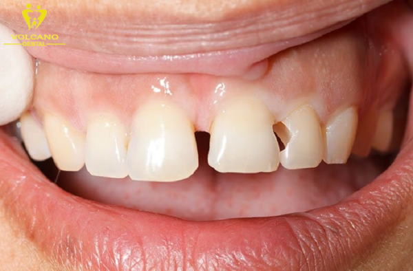 Sức mẻ răng là một trạng thái mà răng bị hư hỏng và mất đi một phần vùng men bên ngoài